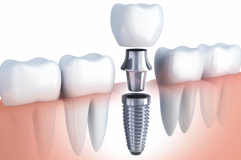 Implant Dentistry in Wilsonville