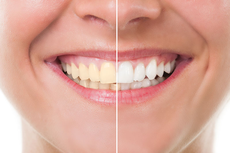 Teeth Whitening in Wilsonville