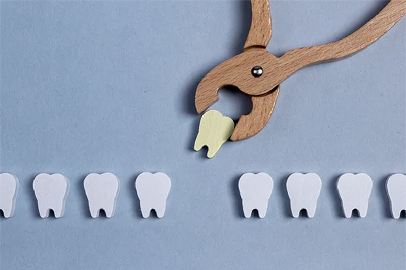 Tooth Extractions in Wilsonville