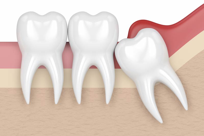 Wisdom Tooth Removal in Wilsonville