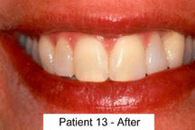 Wilsonville Dental Patient 9 - After